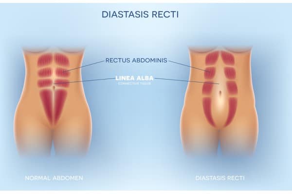 What Non-Surgical Options Are Available for Diastasis Recti Staffordshire ?