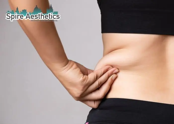 Image of woman pinching fat on their hips Staffordshire . Fat Freezing treatment