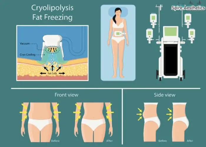 Fat freezing treatment Staffordshire benefits for competitions to remove stubborn fat deposits.