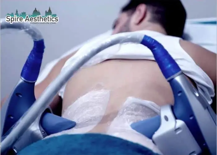 Man having fat freezing treatment done on love handles before a competitions Staffordshire to create a sculpted look.