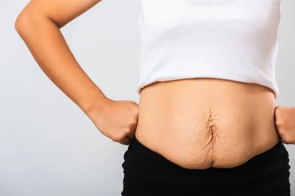 Image of a woman's stomach after weight loss with sagging skin following a gastric band Staffordshire