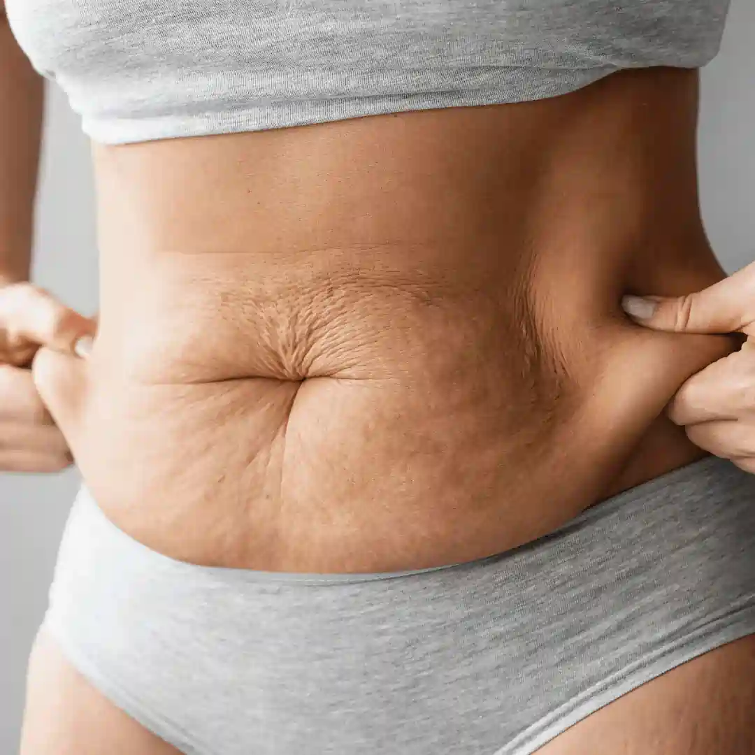 Is It Normal to Have Loose Skin After Pregnancy Staffordshire ?
