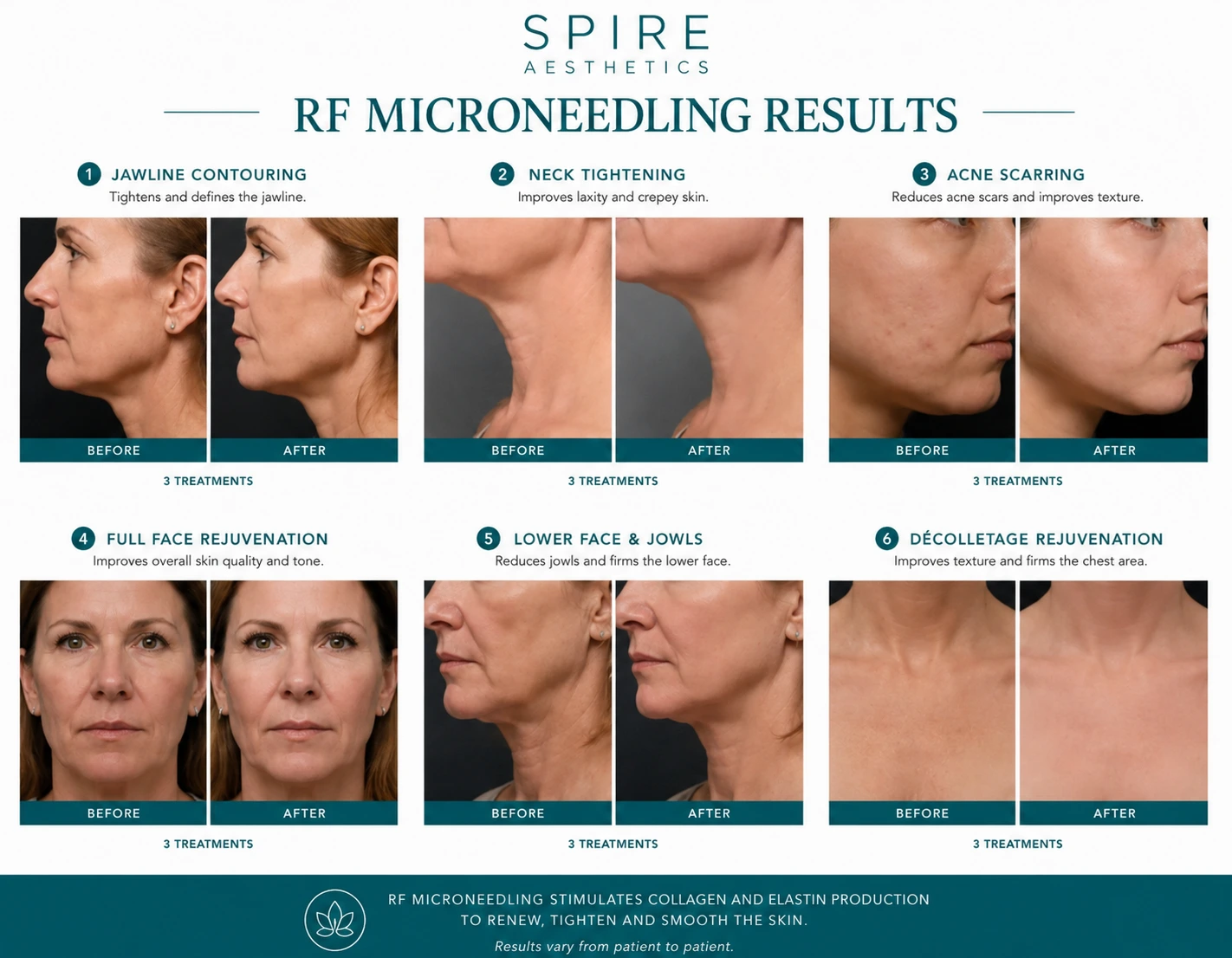 RF Microneedling Skin tightening Staffordshire results