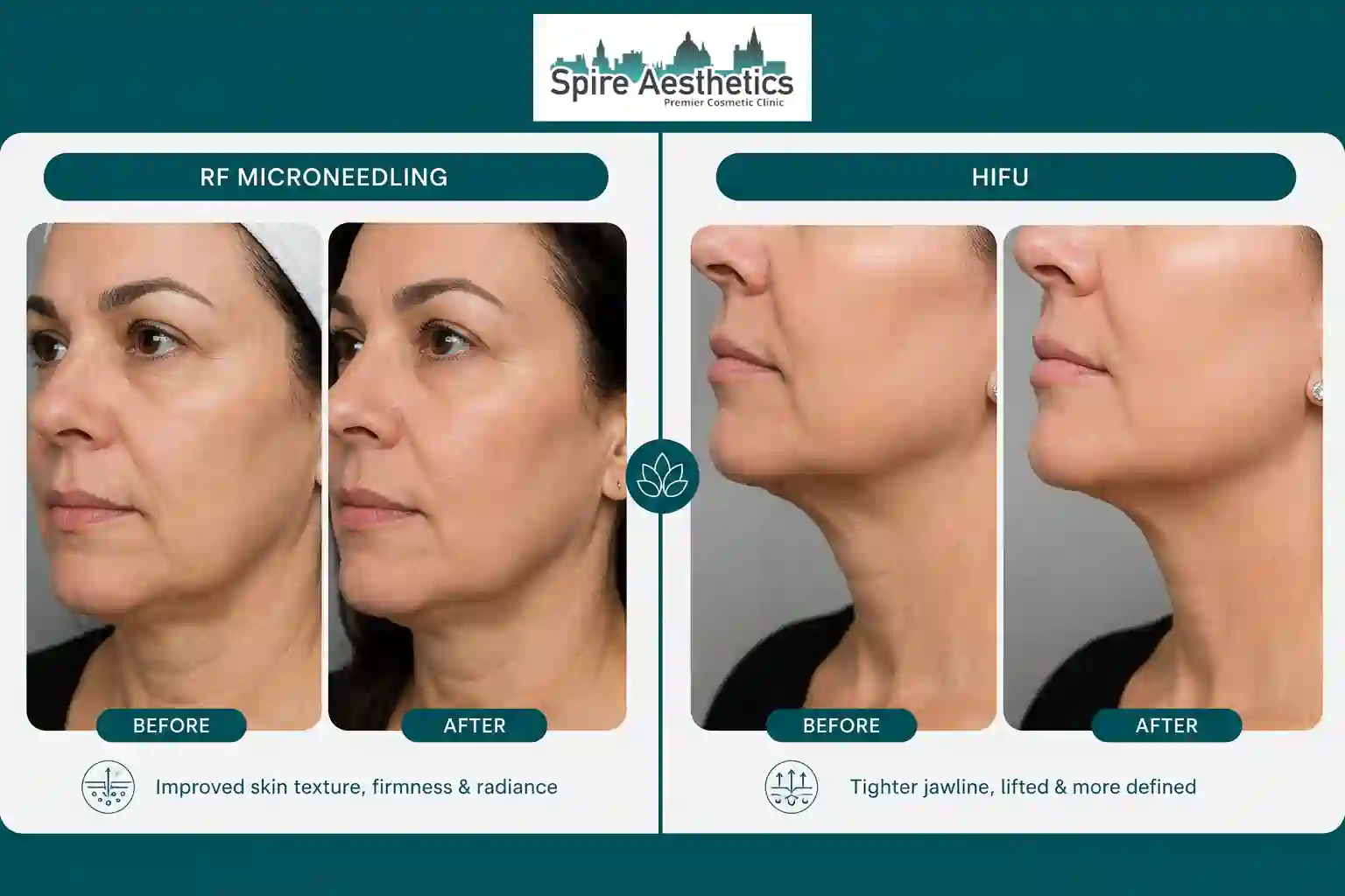 Can RF Microneedling and HIFU Be Combined Staffordshire ?