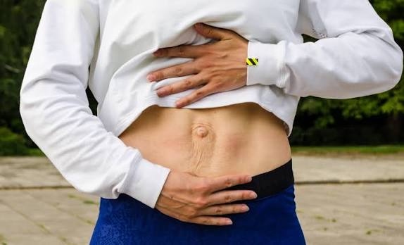 When Could Diastasis Recti Be the Missing Piece of the Puzzle Staffordshire ?