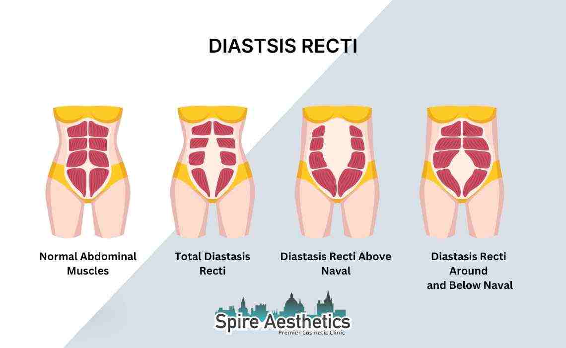 Is Non-Surgical Diastasis Recti Treatment Right for You? Common Concerns Answered Staffordshire